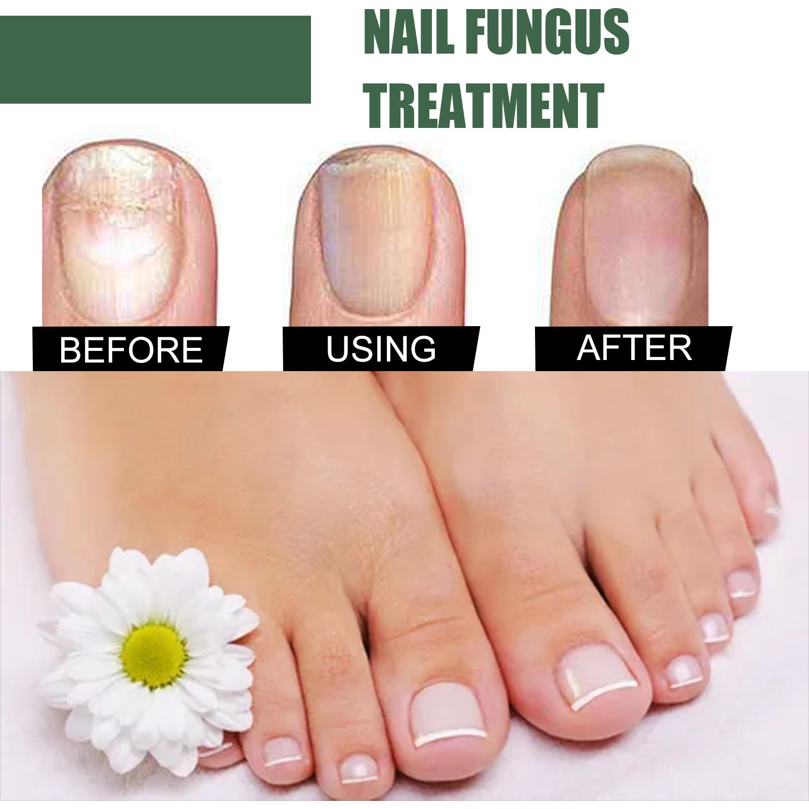 EELHOE Nail Fungus Treatment product display showing green packaging box and amber glass bottle with dark screw cap