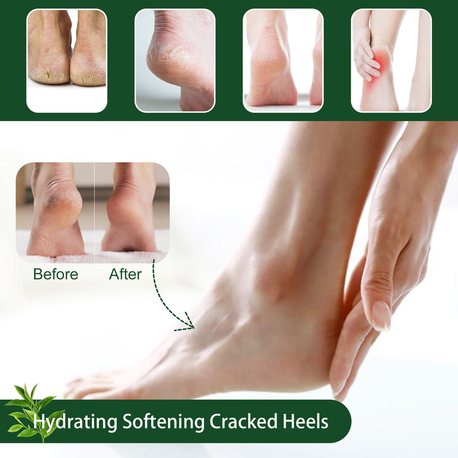 Tea Tree Foot Cream for Softer, Smoother Cracked Heels