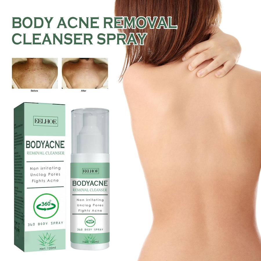 Body Acne Spray for Back, Chest & Shoulder Breakouts