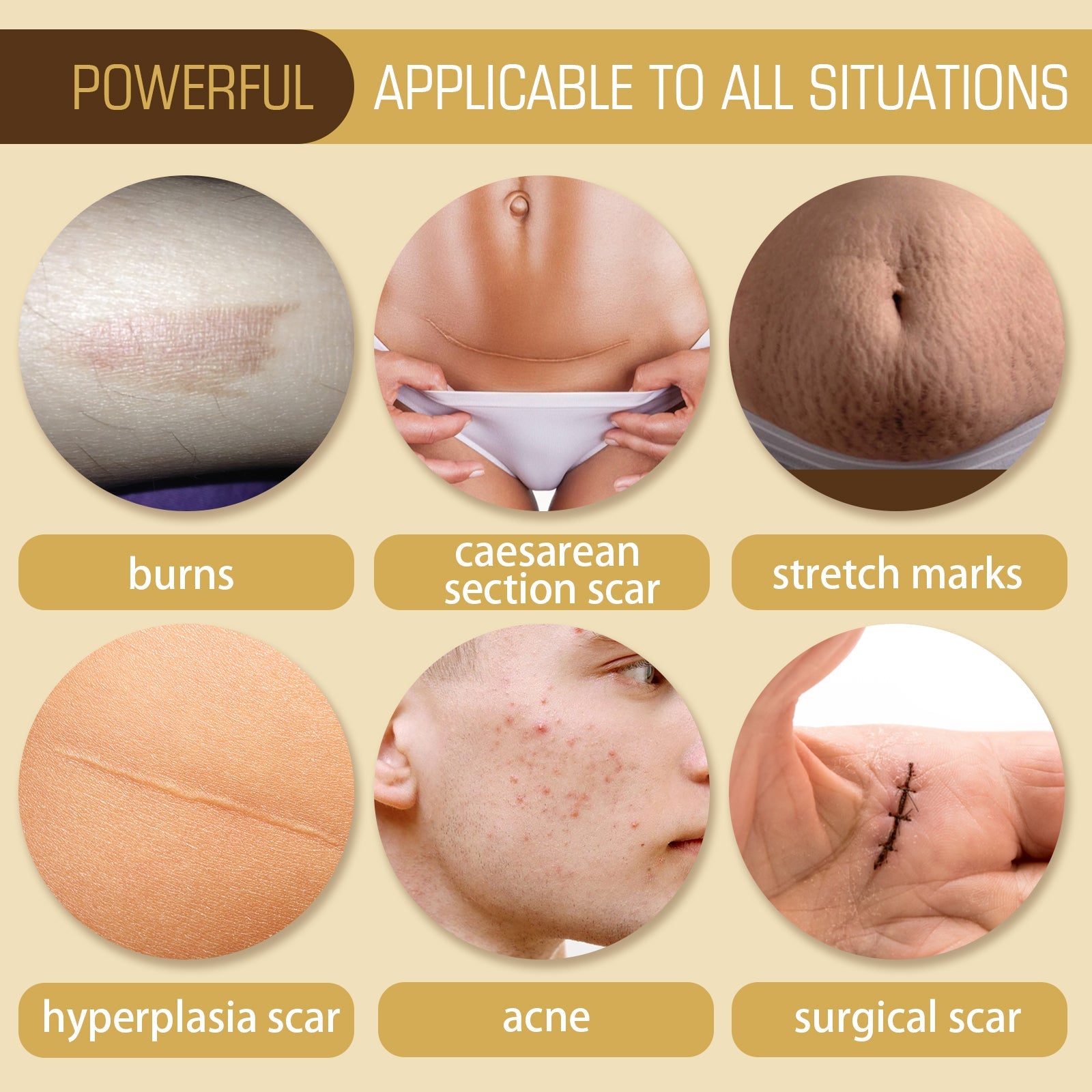 Six circular images showing different scar and mark types: burns, caesarean scars, stretch marks, hyperplasia scars, acne, surgical scars