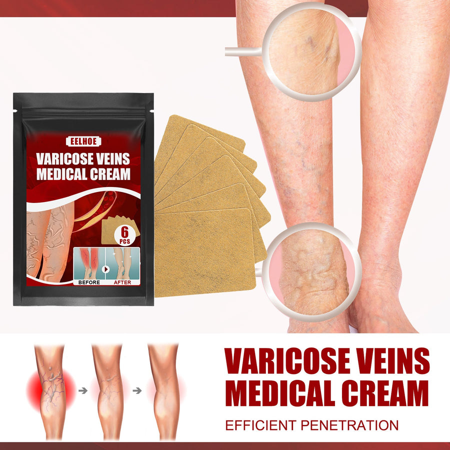 Varicose Vein Cream & Patches — Smoother Legs, Less Swelling