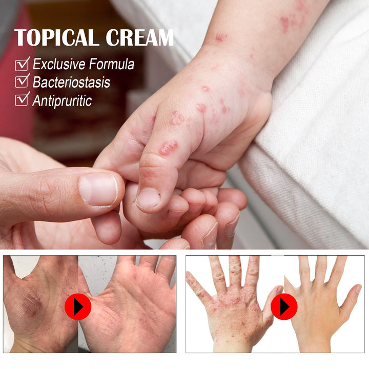 Anti-Itch Cream — Fast Herbal Relief for Bug Bites & Rashes