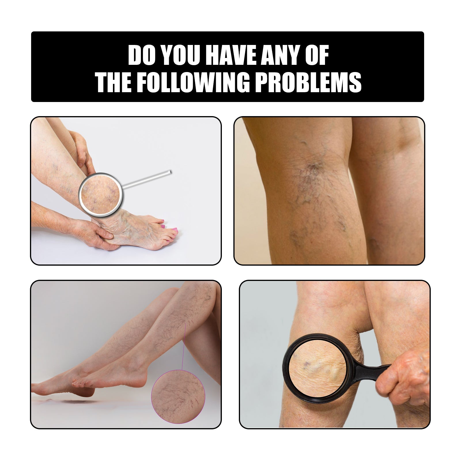 Close-up detail shot showing leg with varicose veins and patch application, with circular magnification showing before treatment appearance and after reduced appearance