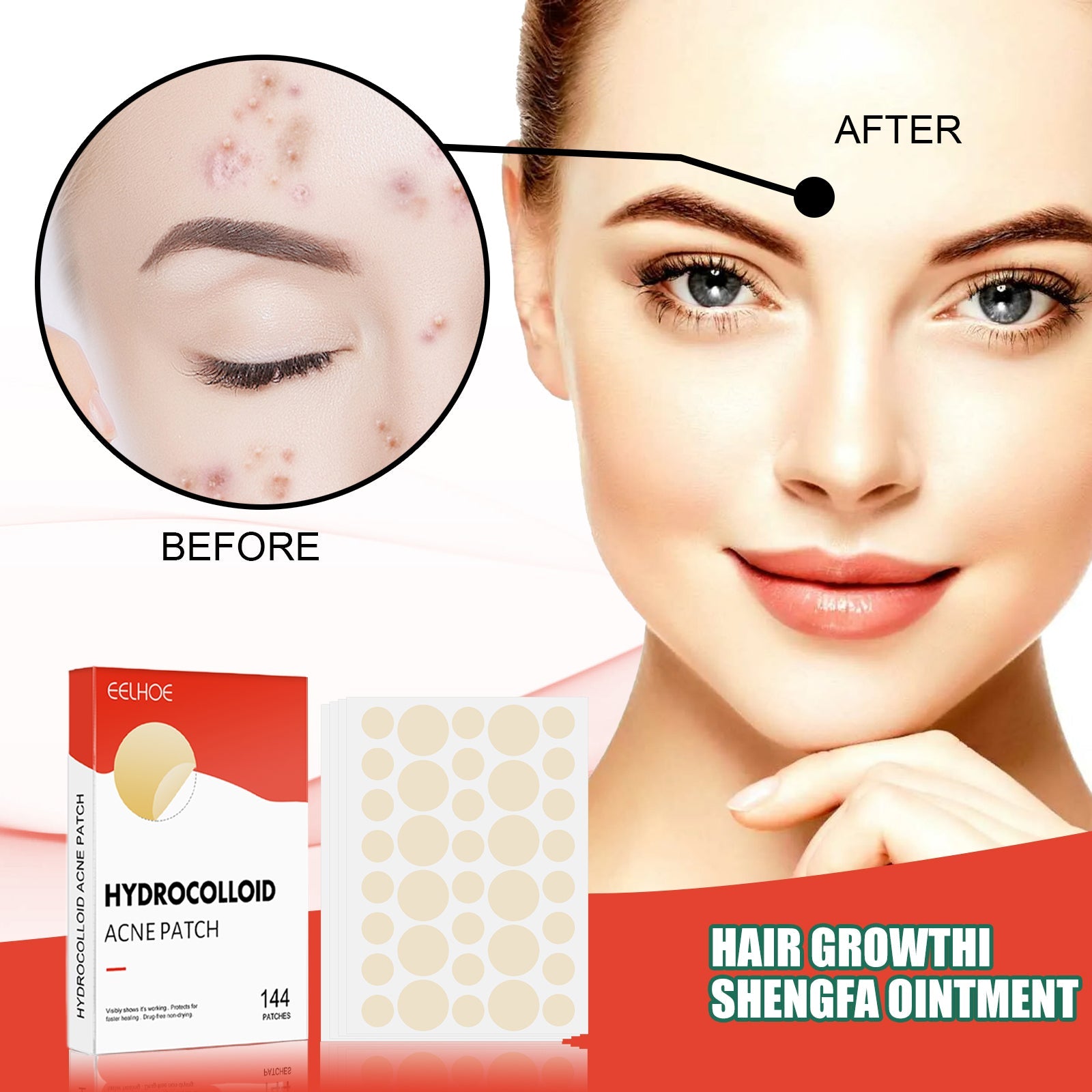 Split comparison showing severe acne before (close-up of inflamed pimples on forehead) versus clear skin after treatment, with model's full face visible on right side