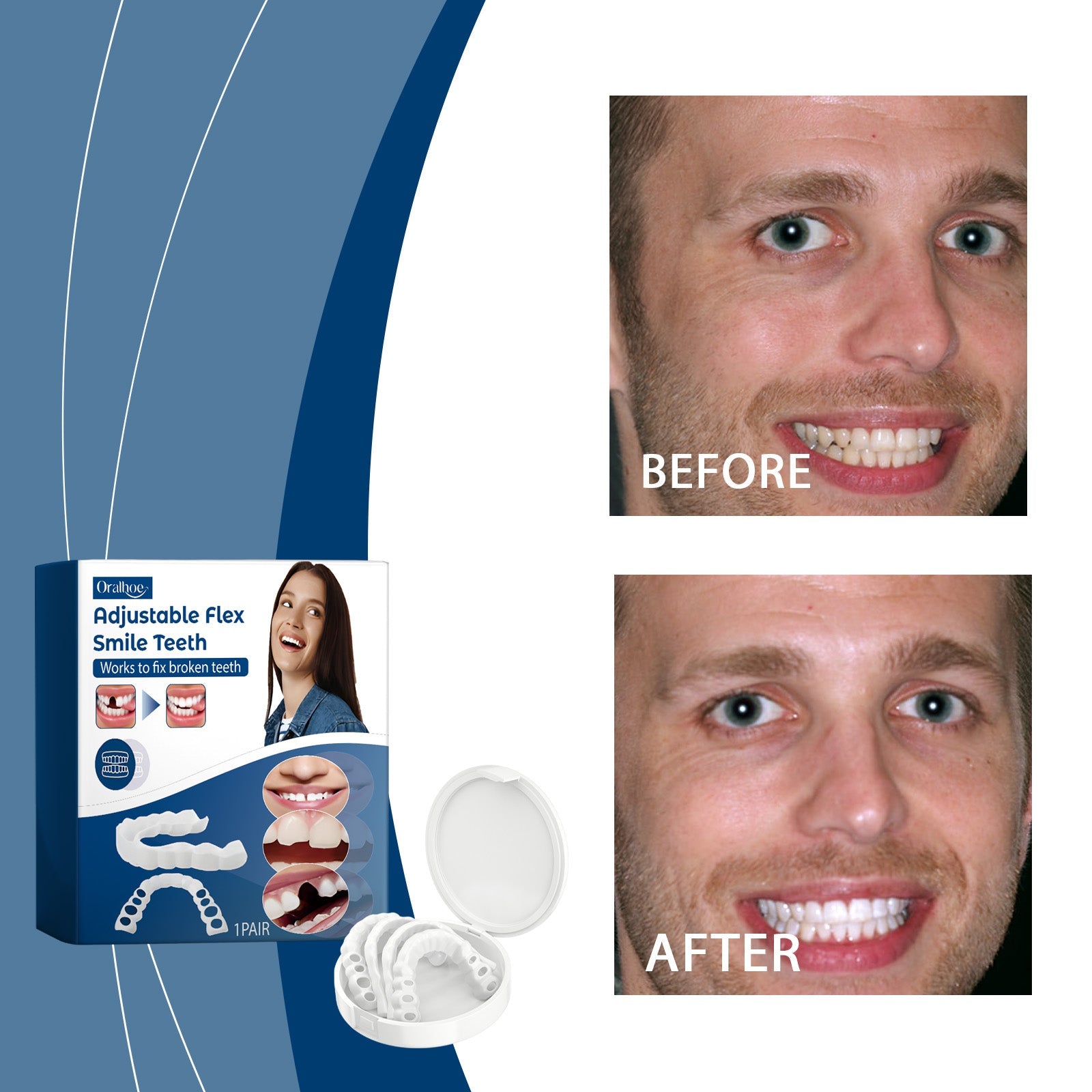 Close-up smile shot showing perfectly aligned bright white teeth with natural appearance