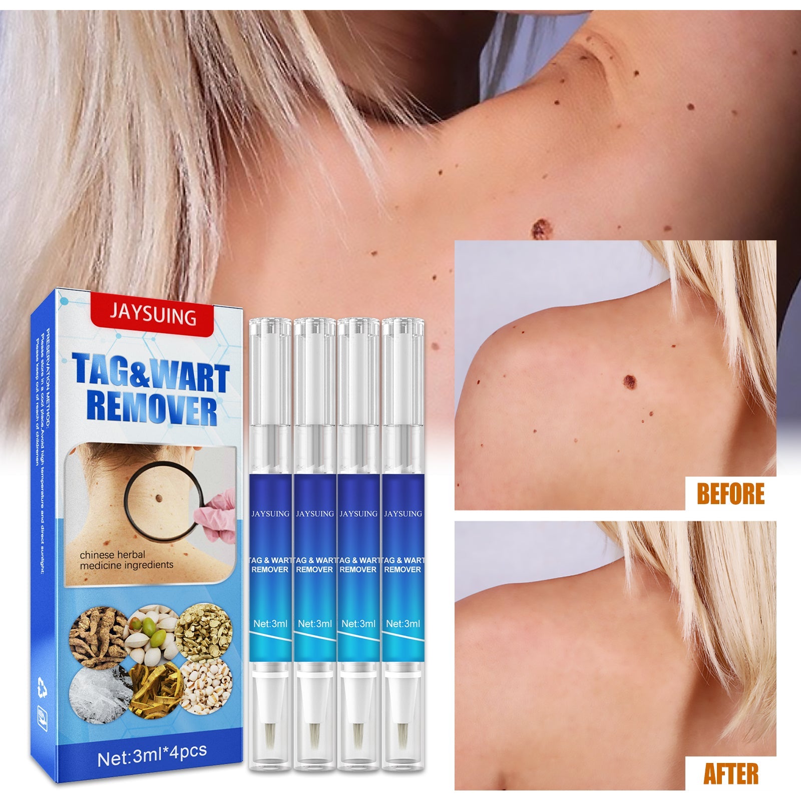 Split-screen showing shoulder with multiple visible skin tags before treatment and clear smooth skin after treatment