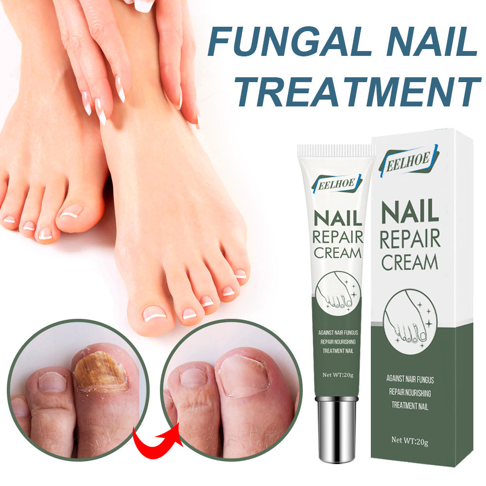 Healthy female feet with white nail polish paired with close-up fungal nail comparison circles showing yellow discoloration before treatment and pink healthy nails after