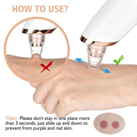 Blackhead Remover Vacuum for Clearer-Looking Pores