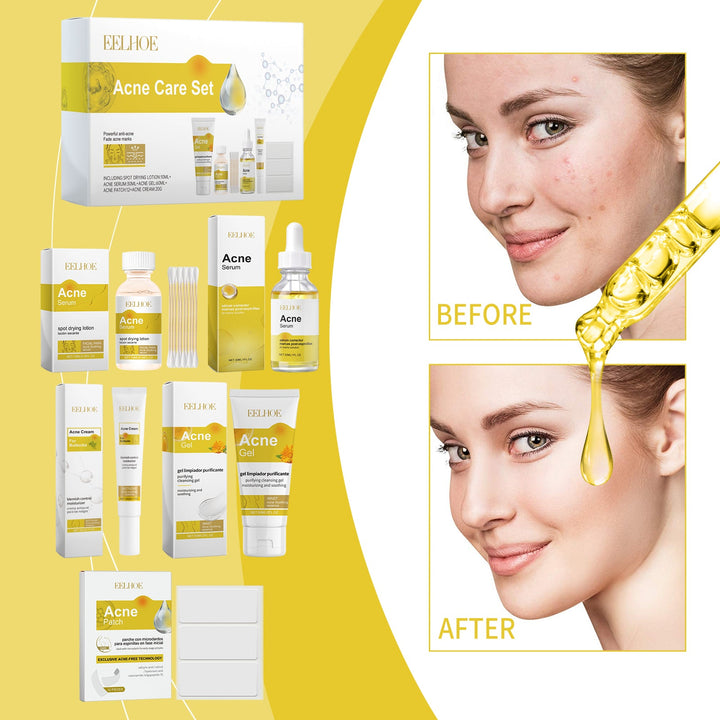 Acne Skincare Set for Oil-Control and Daily Hydration