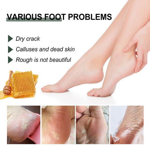 Cracked Heel Cream for Softer Hands, Feet & Calluses