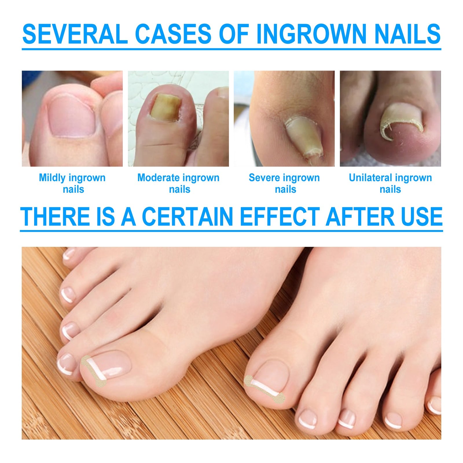 Four clinical close-ups showing mild, moderate, severe, and unilateral ingrown nail conditions