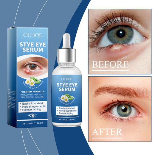 Herbal Eye Drops for Redness, Swelling & Itching Relief