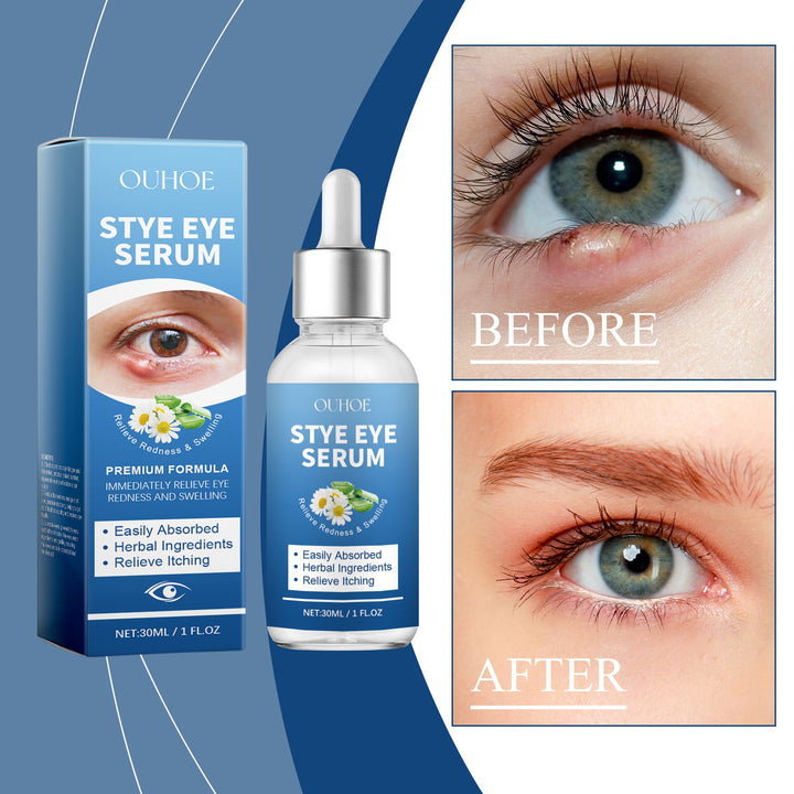Herbal Eye Drops for Redness, Swelling & Itching Relief