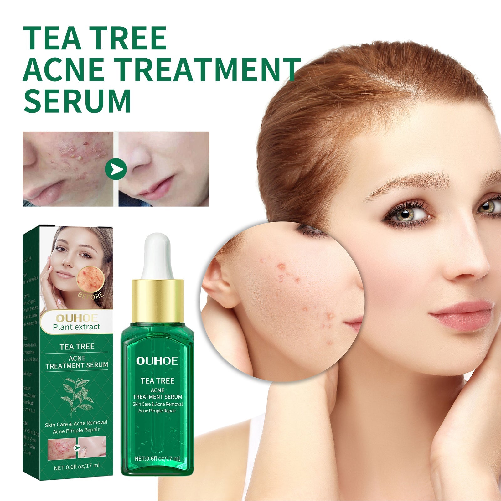 Lifestyle image with model showing acne-prone area and clear skin with product featured