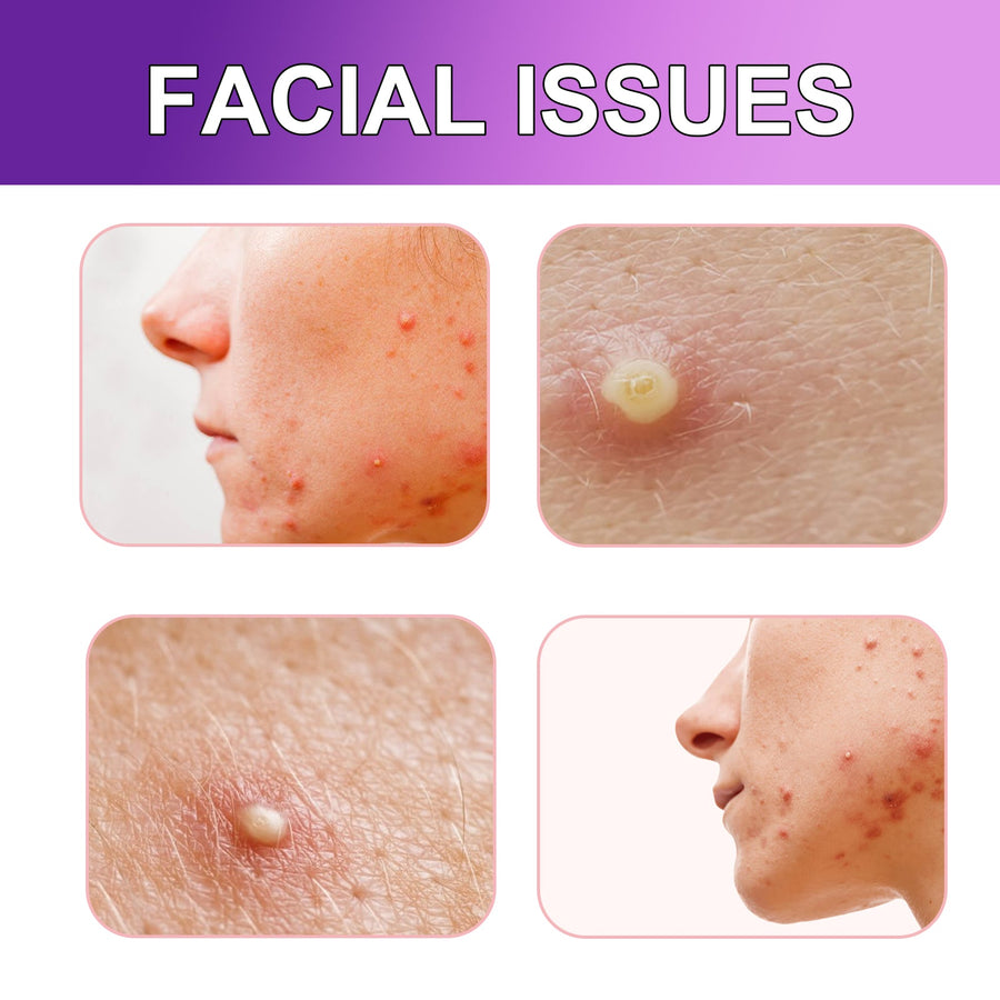 Hydrocolloid Acne Patches for Targeted Blemish Care