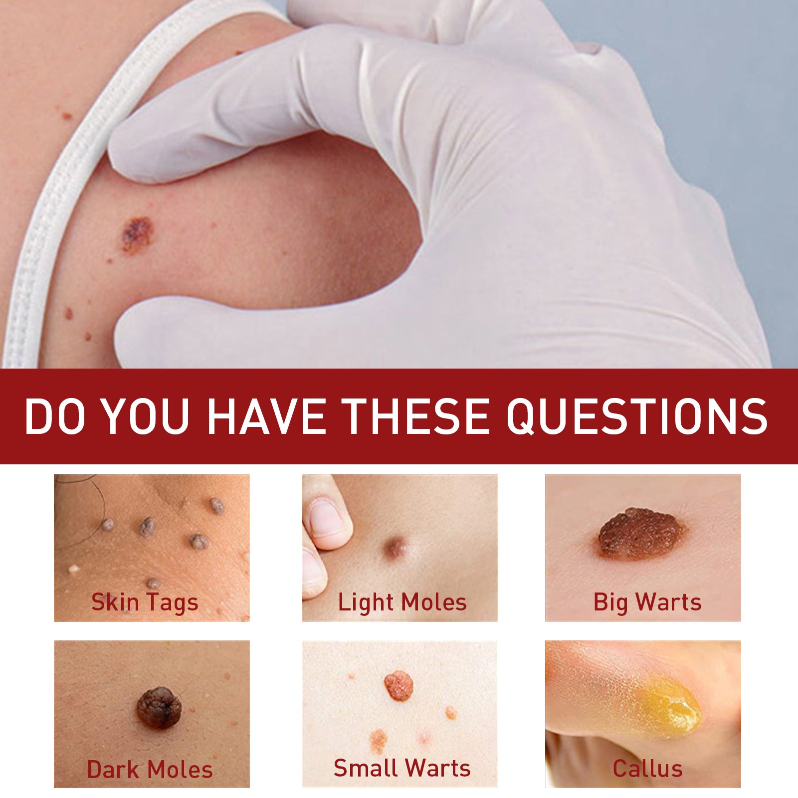Four circular close-ups labeled 'Best For': Spots, Mole, Freckles, Nevus with corresponding skin imagery; model with clear skin smiling