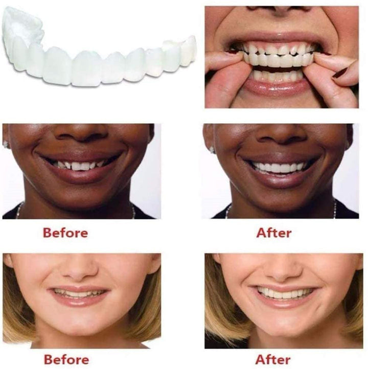 Teeth Simulation Veneers — Instant Bright Smile, No Dentist