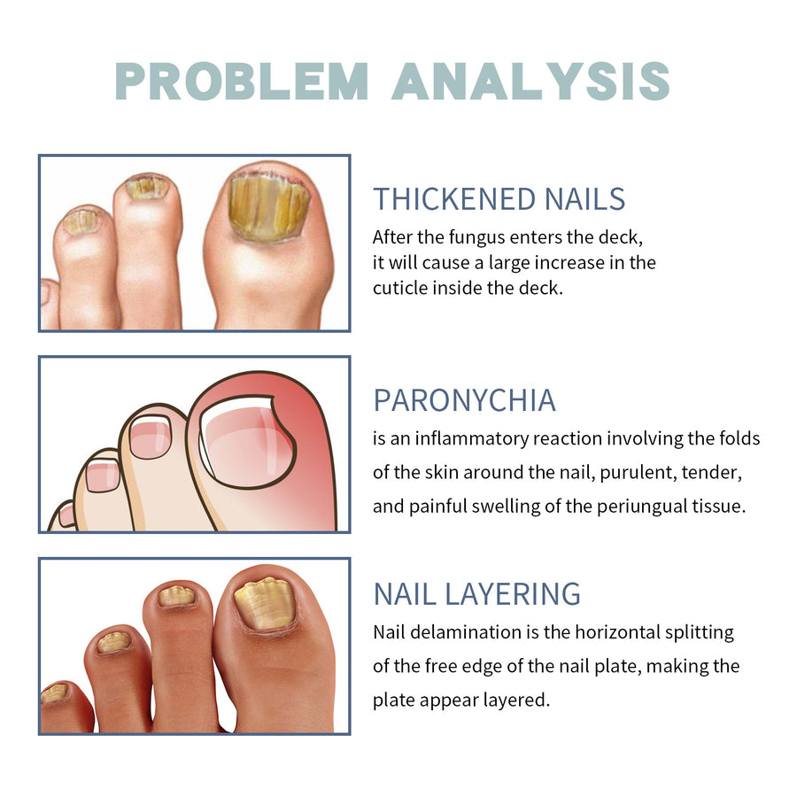 Nail Care Set for Antifungal Repair and Nail Relief
