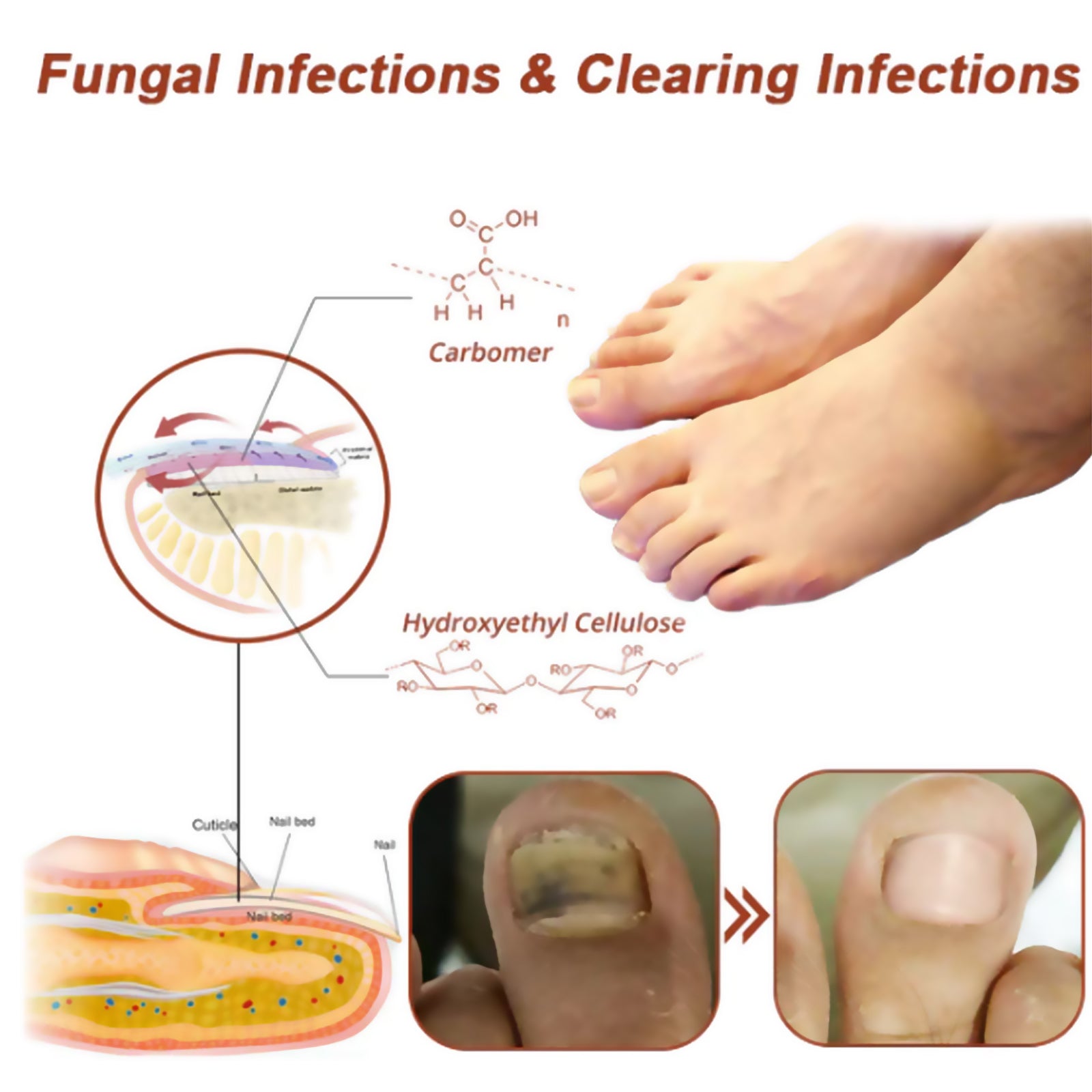 Scientific diagram showing how laser treatment works with chemical compounds carbomer and hydroxyethyl cellulose, plus cross-section of nail with fungus