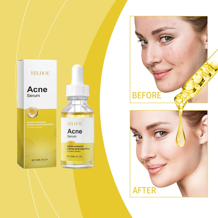 Acne Serum for Dark Spots & Post-Acne Marks