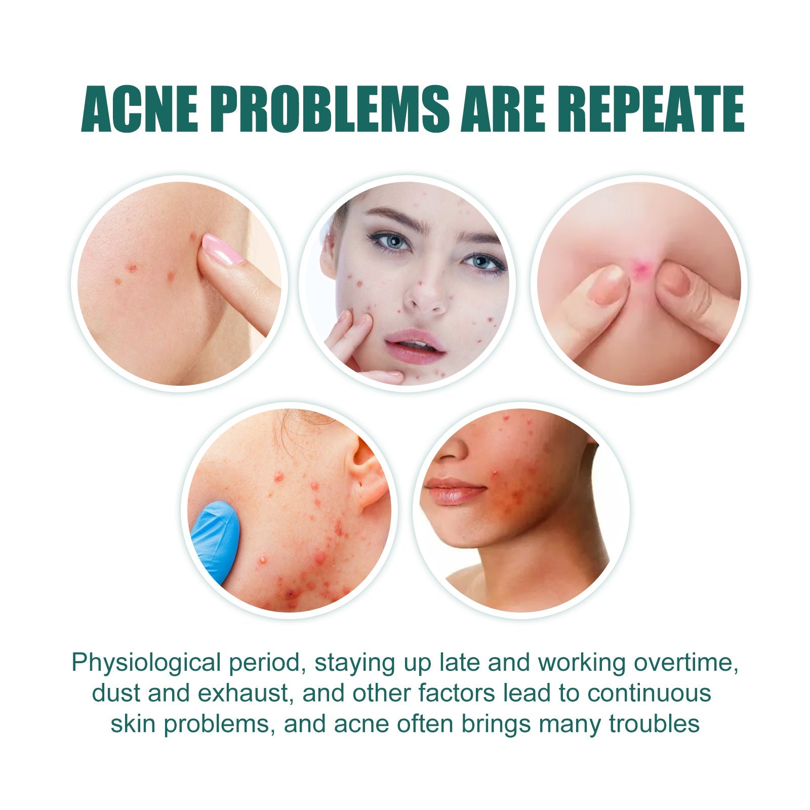 Five circular close-ups showing common acne problems: small pimples, forehead acne, hormonal breakouts, body acne, and severe facial acne