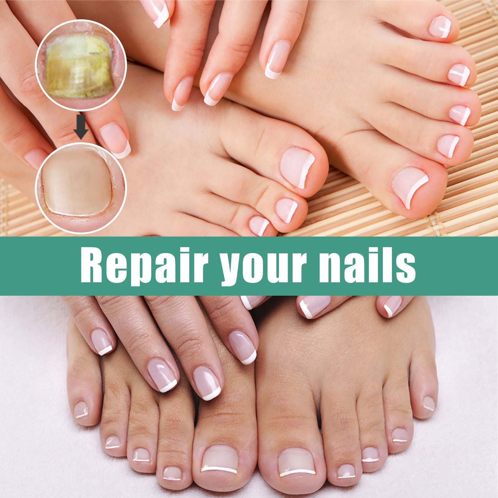 Educational infographic with magnifying glass highlighting fungal infection, nail discoloration, and cracked nails as treatable conditions with progression strips showing recovery stages