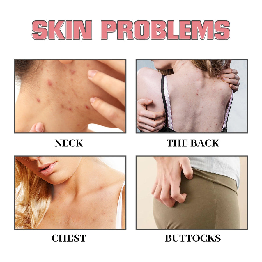 Exfoliating Body Soap for Acne-Prone, Smoother Skin