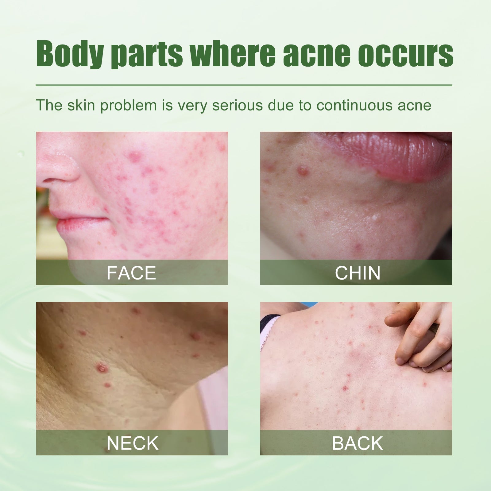 Split-face before/after comparison showing acne reduction; lifestyle shot of woman applying gel to cheek