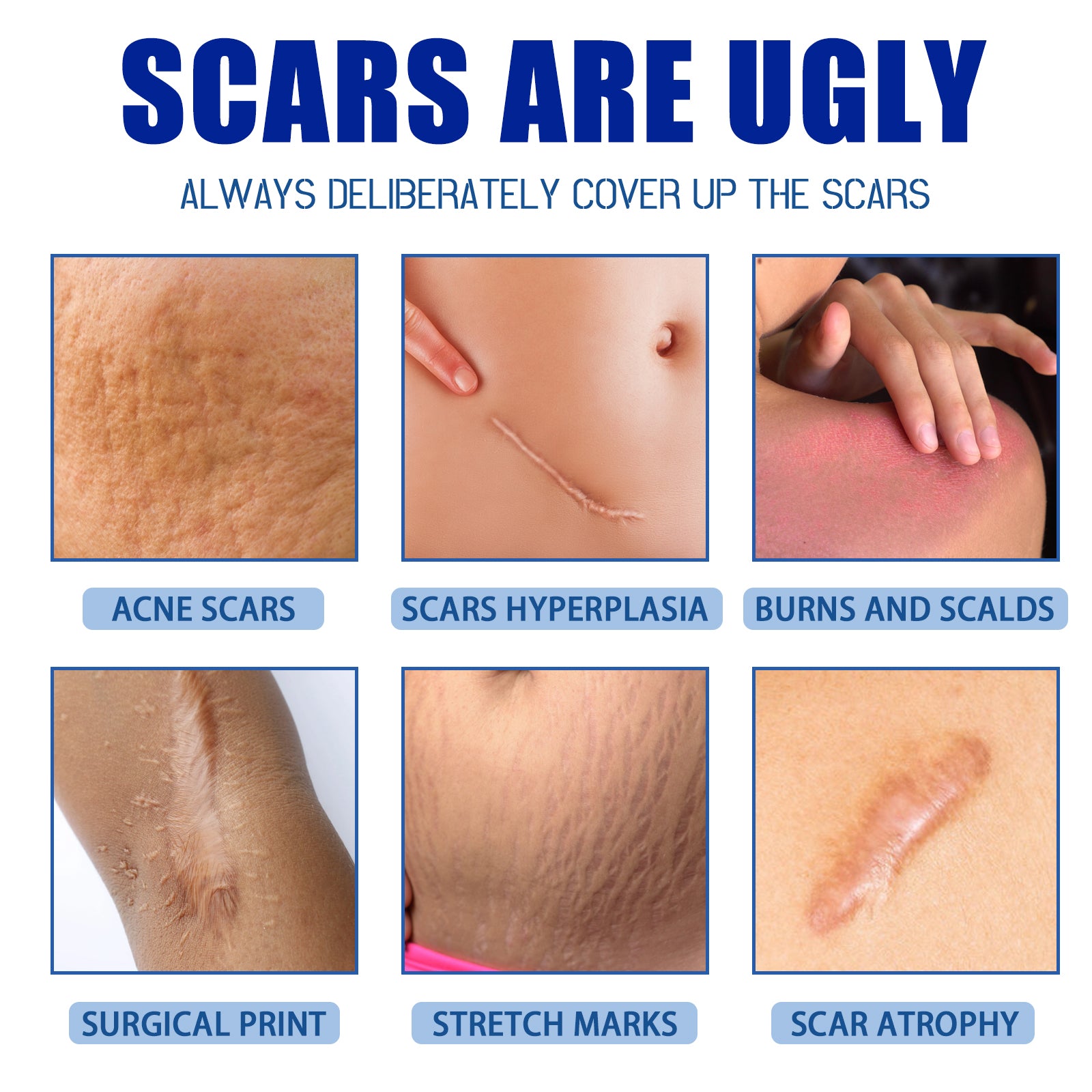 Grid of six scar types showing close-up imagery: acne scars, scar hyperplasia, burns and scalds, surgical print, stretch marks, and scar atrophy