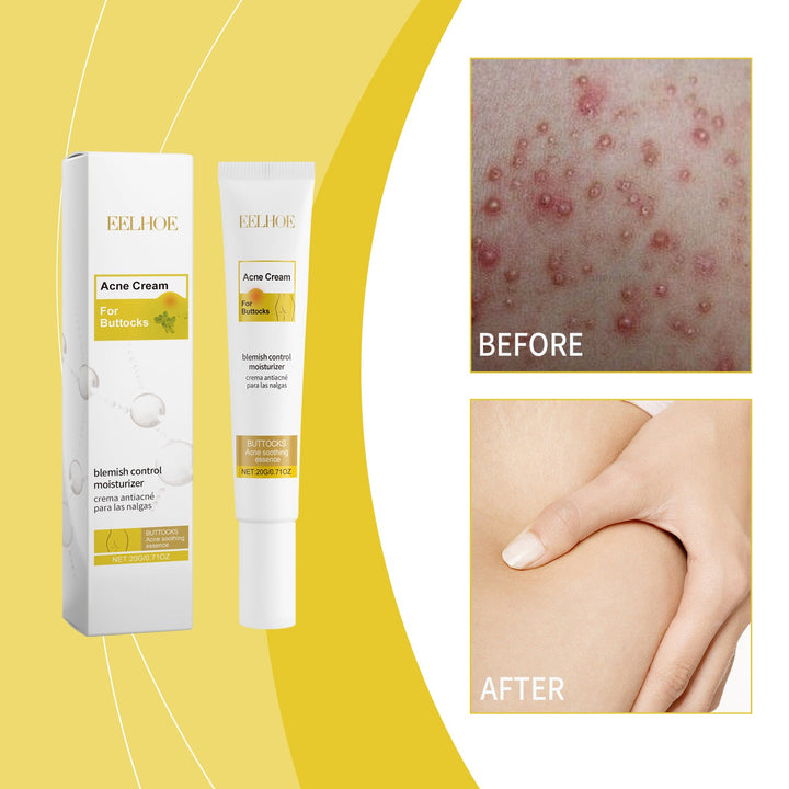 Buttne Acne Cream - Targeted Blemish Control Treatment