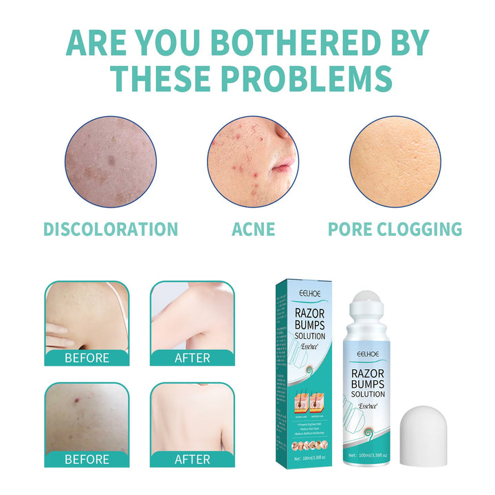 Ingrown Hair Roll-On Treatment — Prevents Razor Bumps