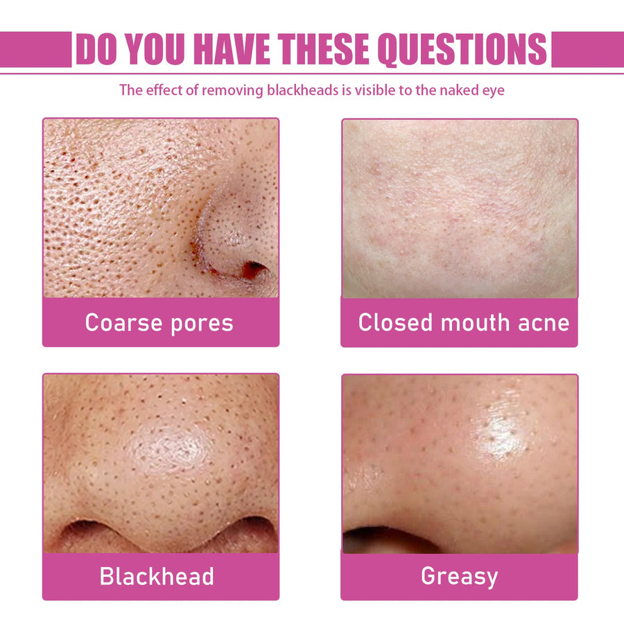 Aloe Vera Blackhead Gel for Clearer-Looking Pores