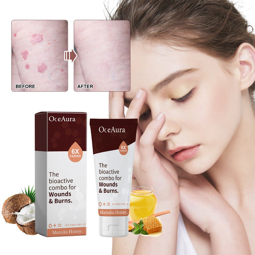 Manuka Honey Wound & Burn Cream, 6X Faster Skin Repair