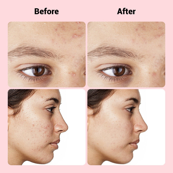 Microneedle Pimple Patches — Targets Deep Hormonal Acne