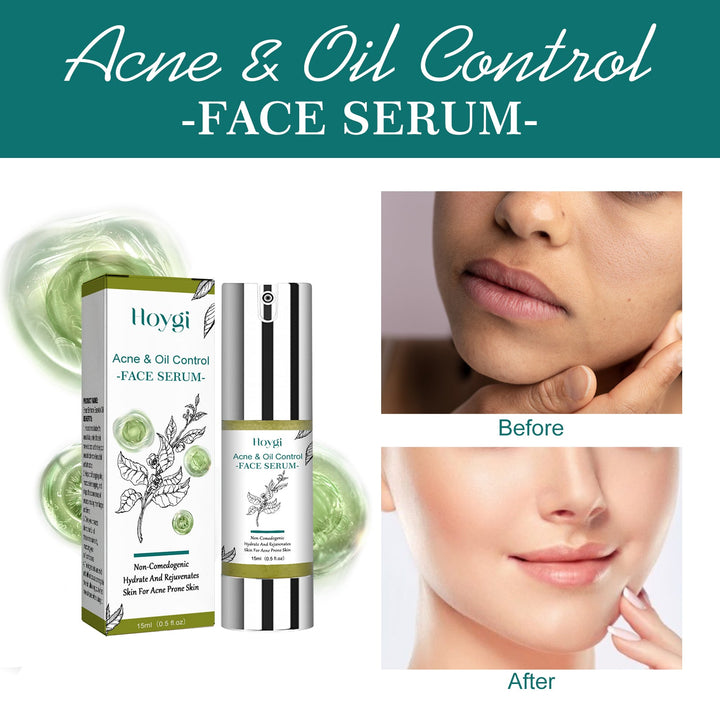 Tea Tree Face Serum for Acne-Prone, Oily Skin Hydration
