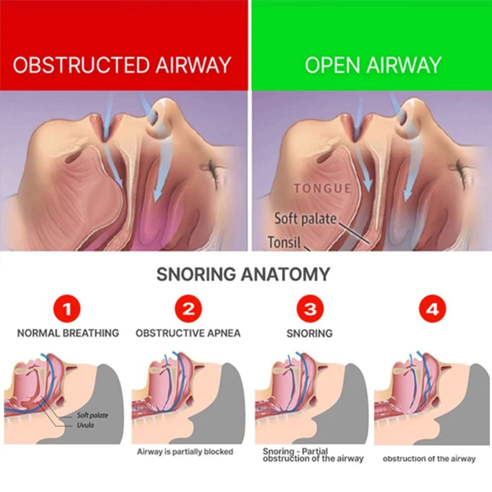 Medical diagram showing obstructed airway vs. open airway anatomy with snoring progression sequence