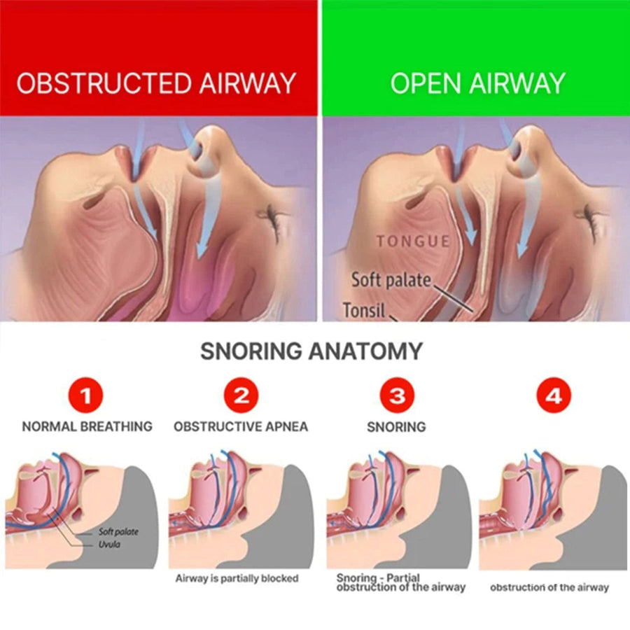 Anti‑Snore Mouthpiece — Quieter Sleep, Open Airway