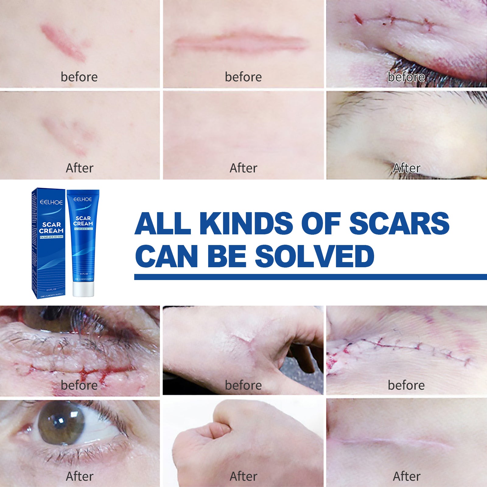 Six-panel before and after treatment grid showcasing various scar locations improving