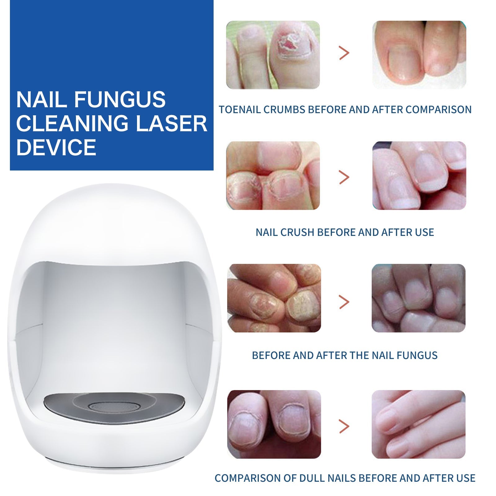 Four sets of before/after nail fungus treatment comparisons showing toenail crumbs clearing, nail crush healing, fungal nails becoming clear, and dull nails regaining shine