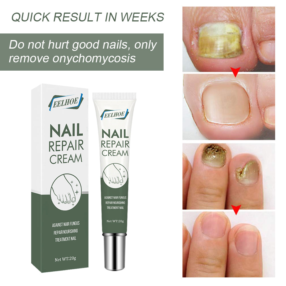 Four-stage progression of nail treatment from yellow fungal infection to clear pink healthy nail