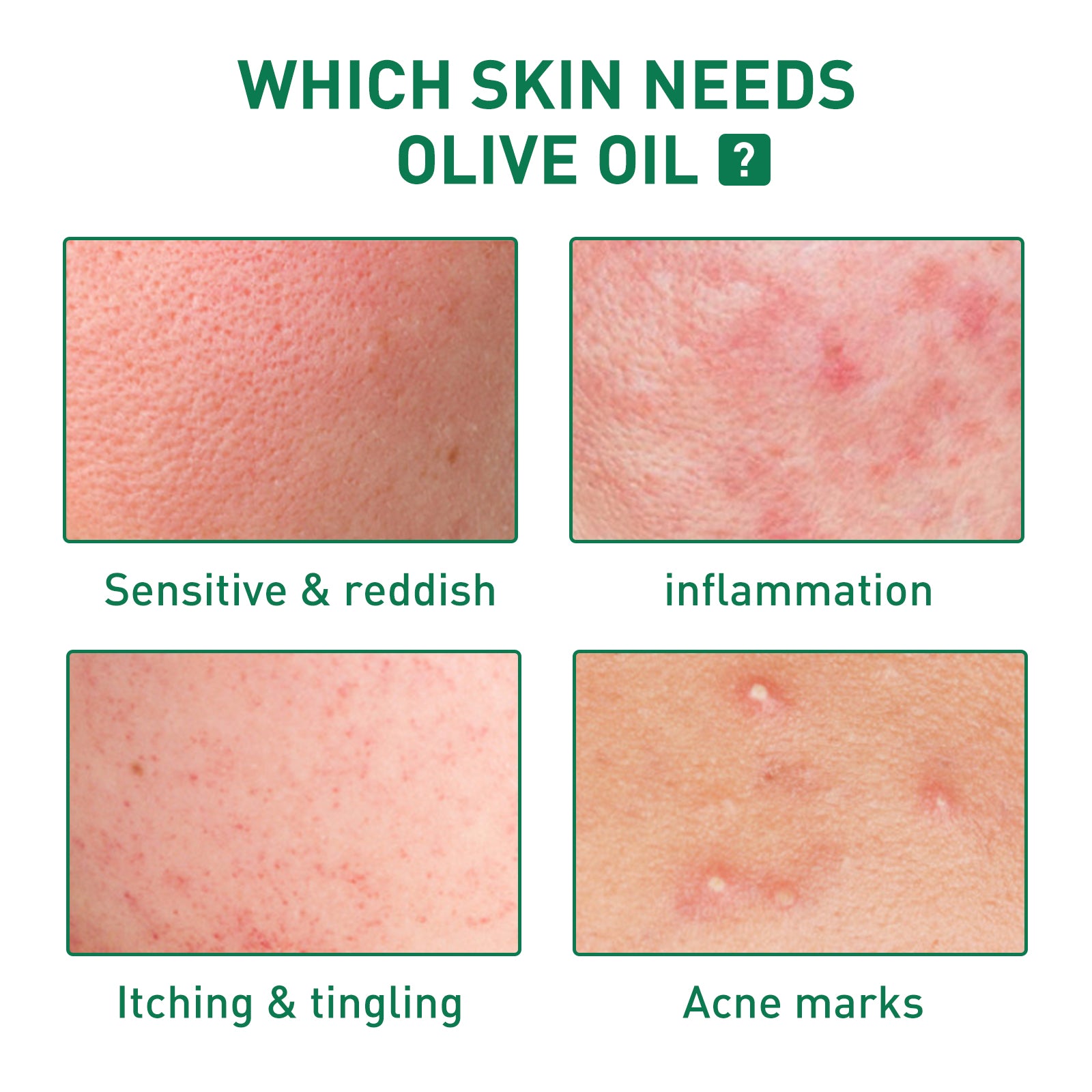 Educational skin condition guide showing four acne types that need treatment