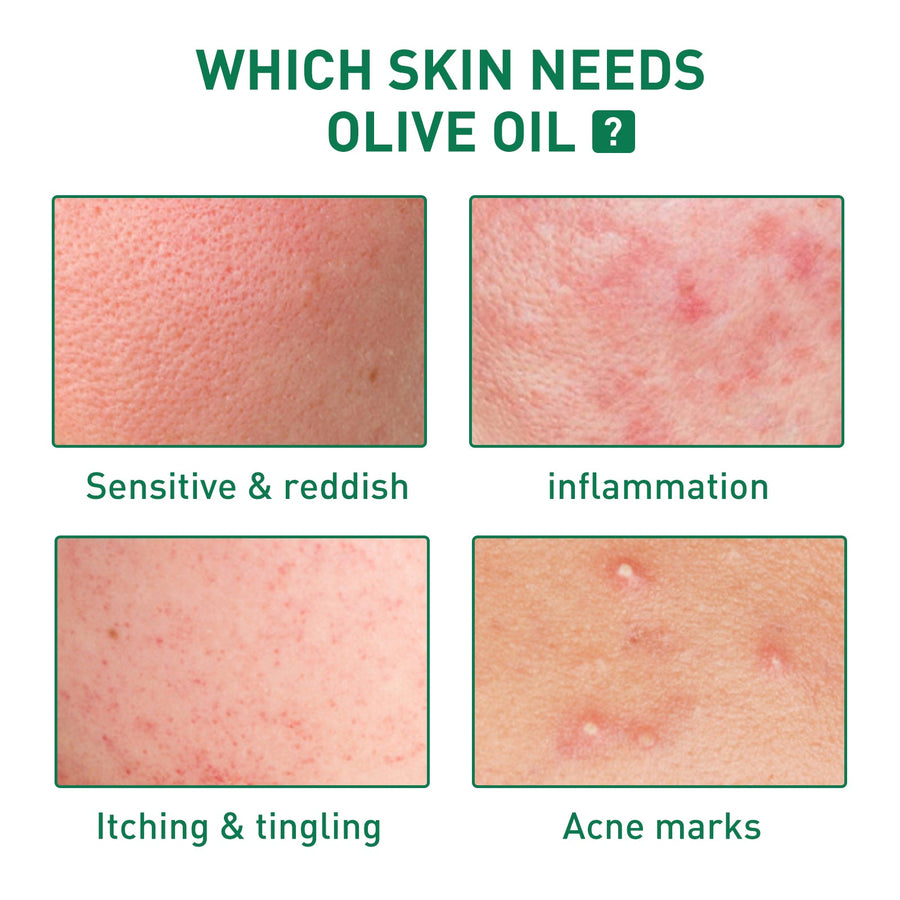 Tea Tree Oil Acne Serum — Clearer, Smoother Skin in 2 Weeks