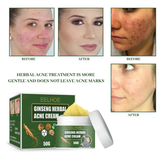 Herbal Ginseng Acne Cream — Clears Breakouts, No Scars