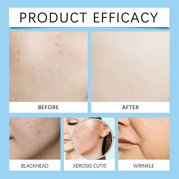2% Salicylic Acid Serum for Acne Without Dryness