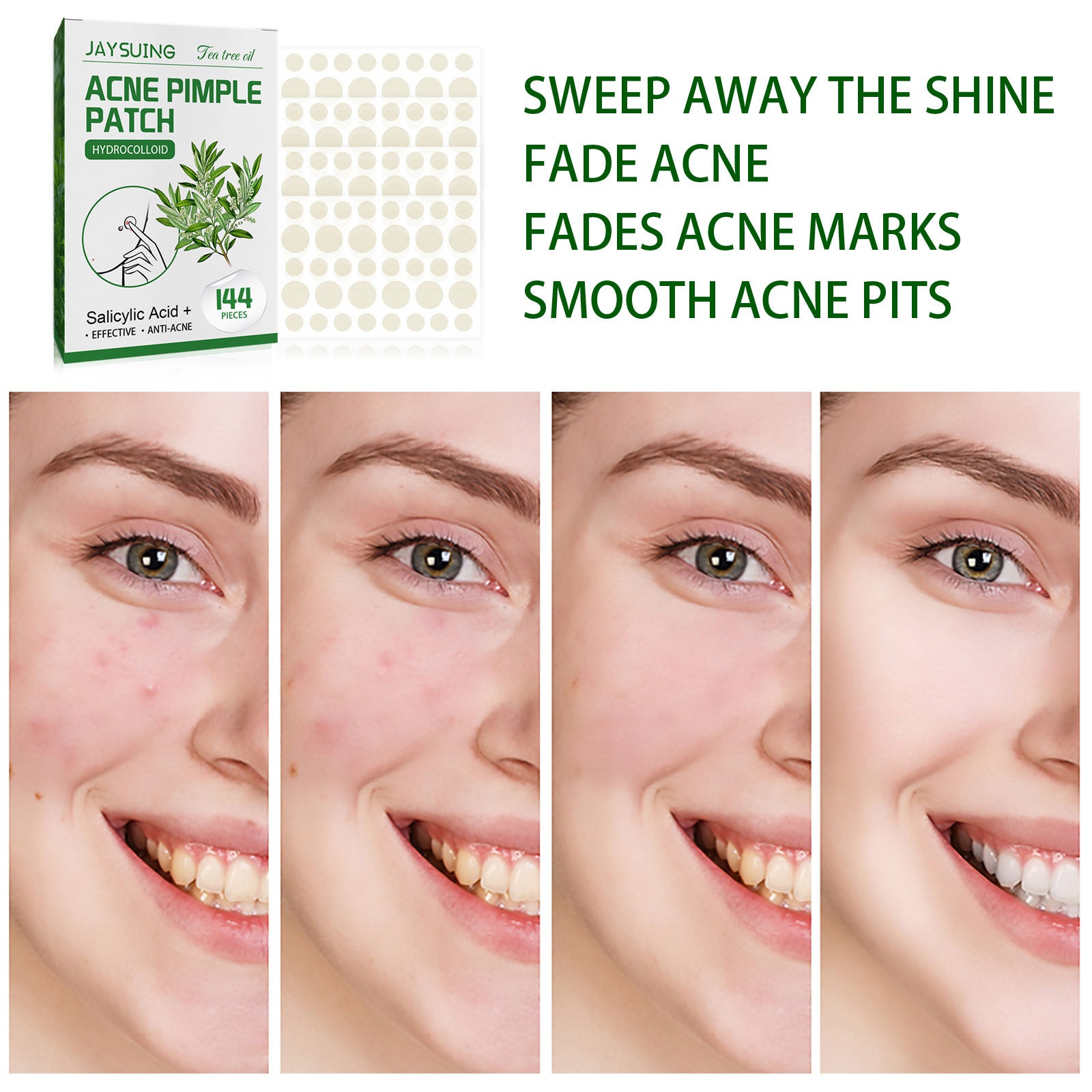 Four-stage progression showing same woman's cheek from acne-prone with visible pimples to progressively clearer skin with reduced redness and flattened blemishes