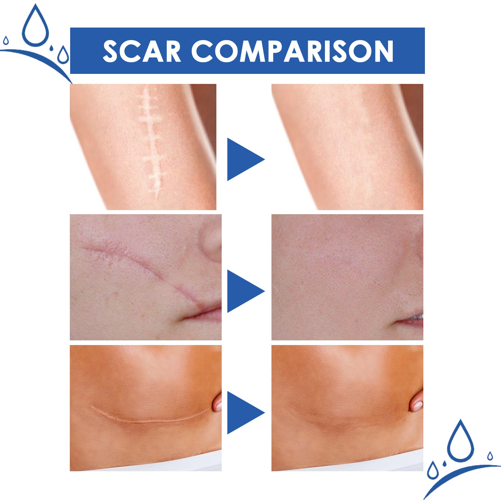 Three pairs of before/after scar comparison photos showing surgical scar fading, facial scar softening, and abdominal stretch mark reduction
