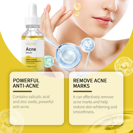 Acne Serum for Dark Spots & Post-Acne Marks