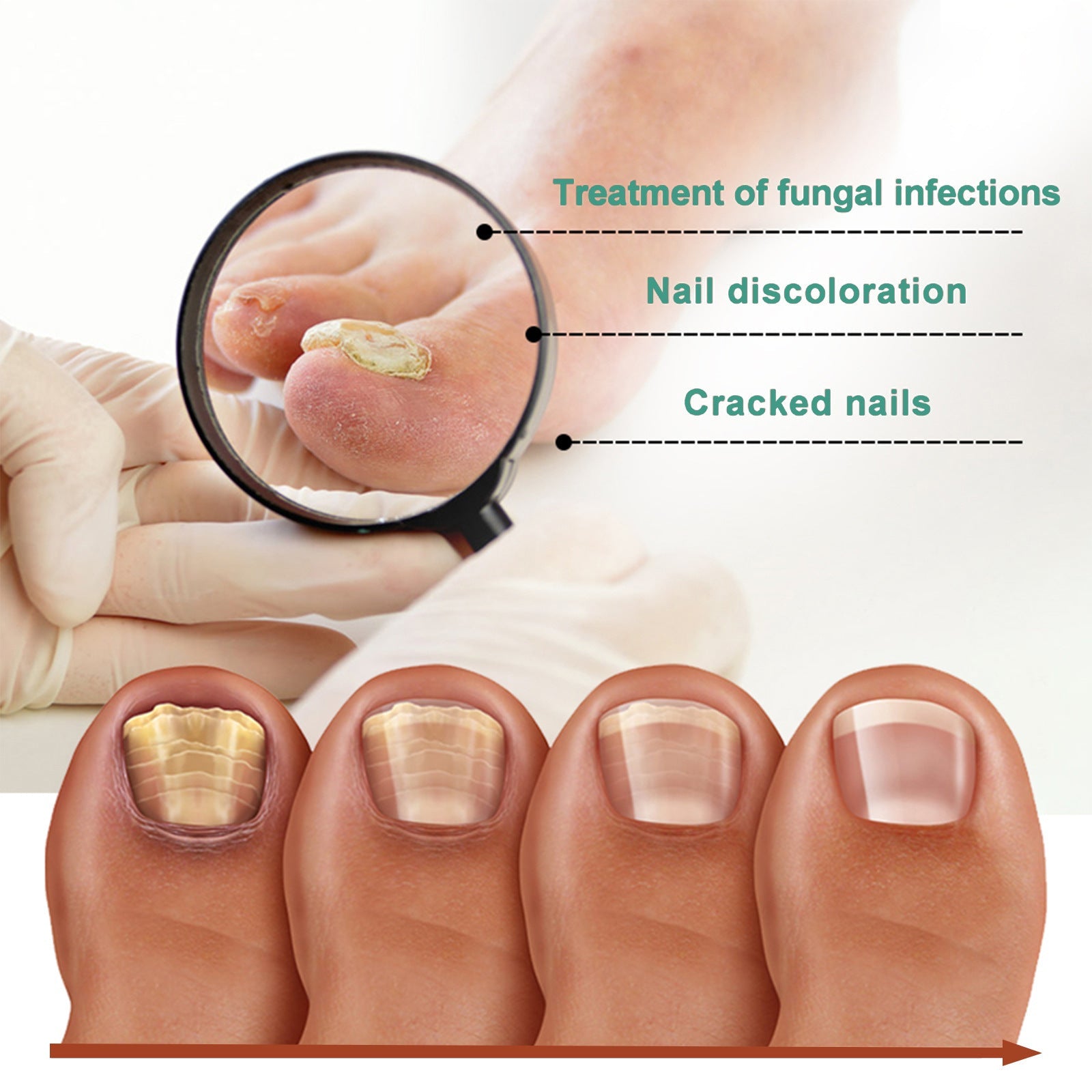 Lifestyle scene of healthy feet and hands alongside magnified before/after close-ups of fungus-infected nails transforming to clear healthy nails