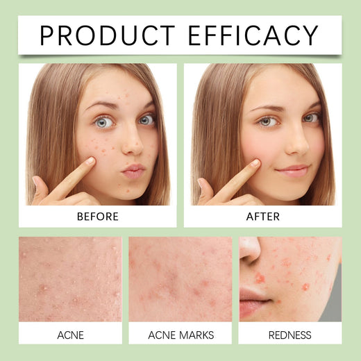 Anti-Acne Patches - Gentle Herbal Blemish Spot Treatment