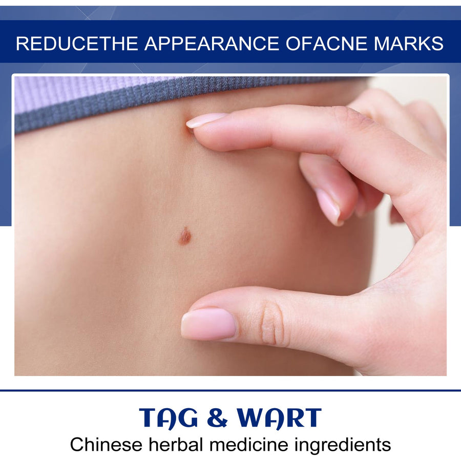Wart Remover Ointment — Painless Herbal Wart & Skin Tag